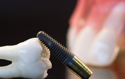 היתרונות של השתלת שיניים ממוחשבת